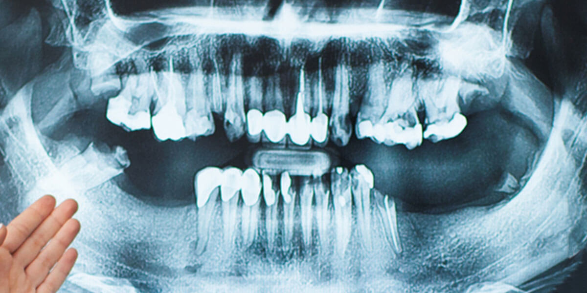 Dental x-rays